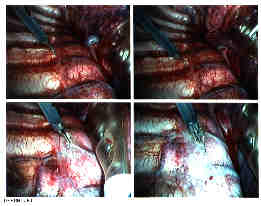 four views using hook cautery